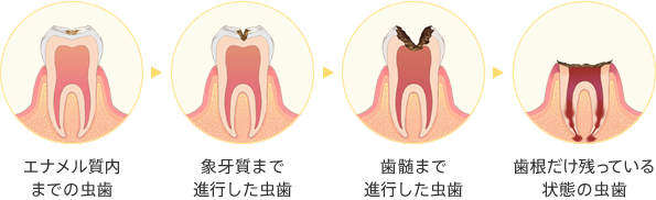 虫歯の進行